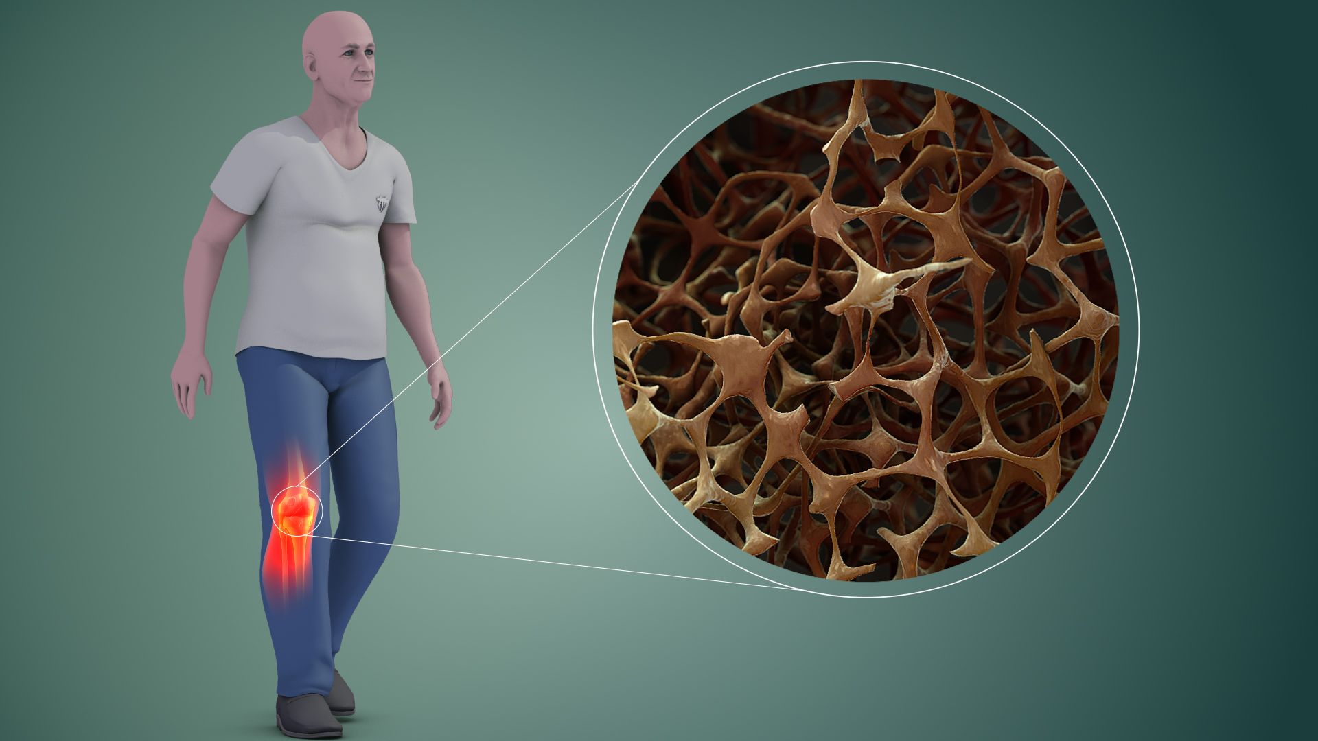 Reproducció del fenomen que genera l'osteoporosi, el "mal silenciós" - Foto: Bones CC