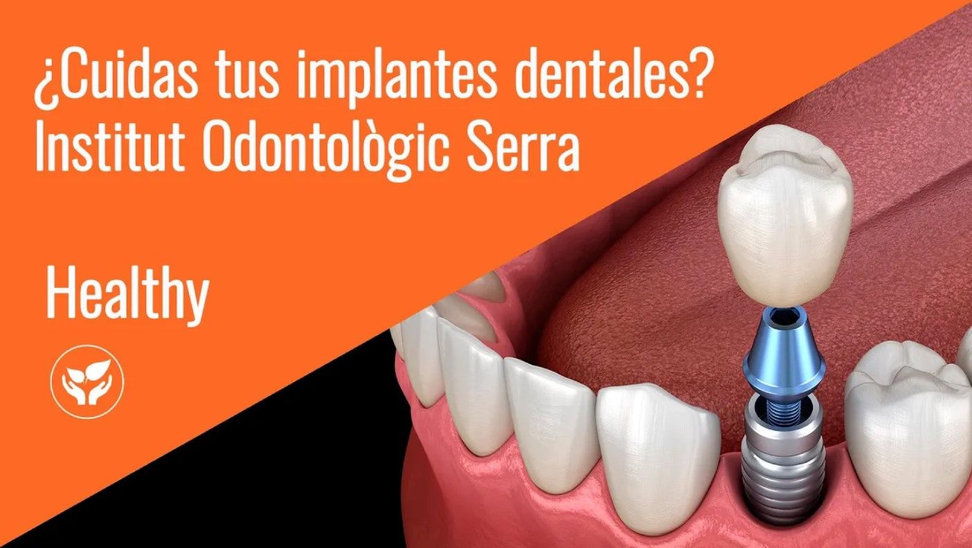 Cuides els teus implants dentals com cal?