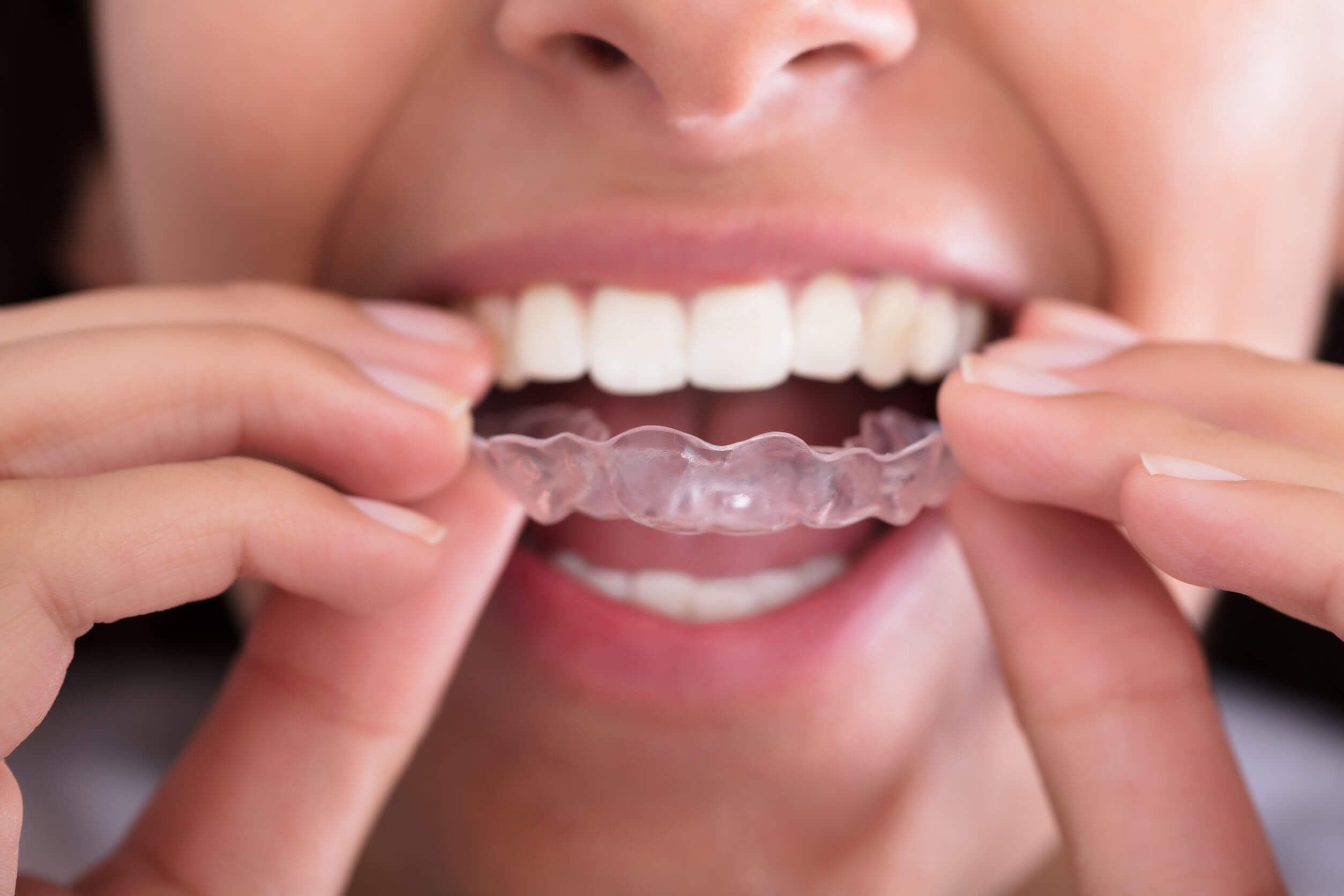 Fèrules dentals