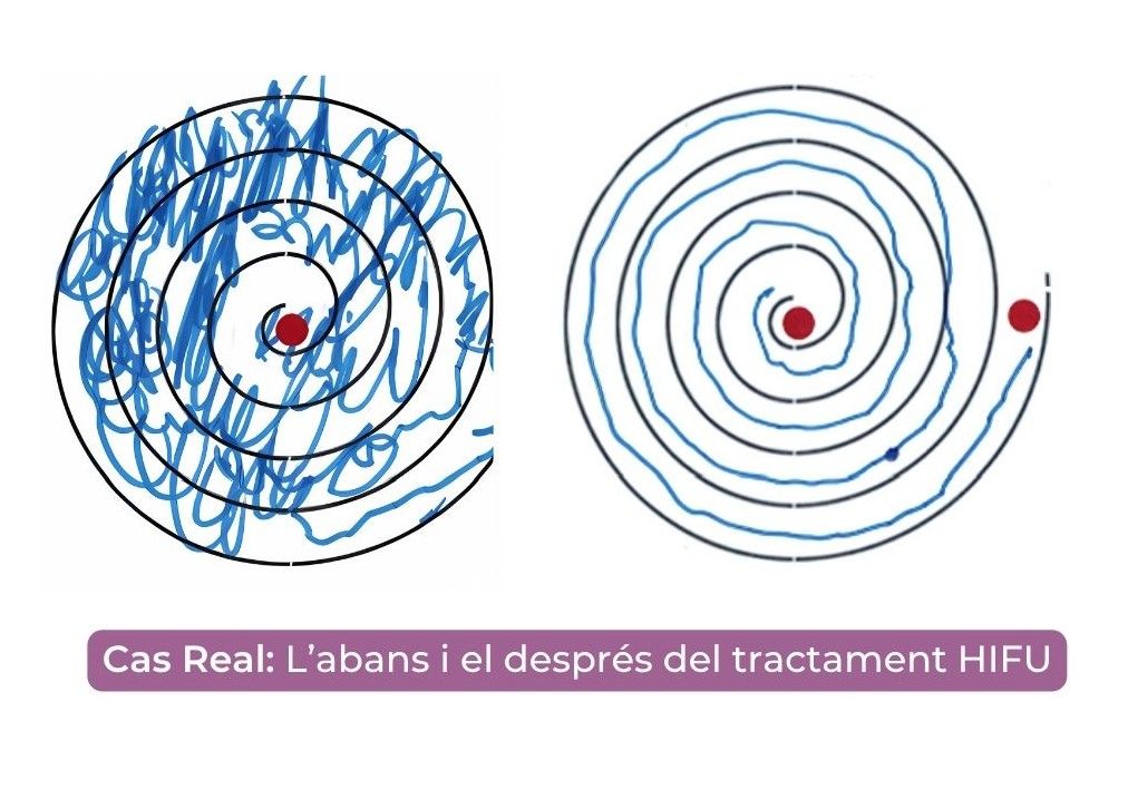 Alomar caso real HIFU Alomar caso real HIFU